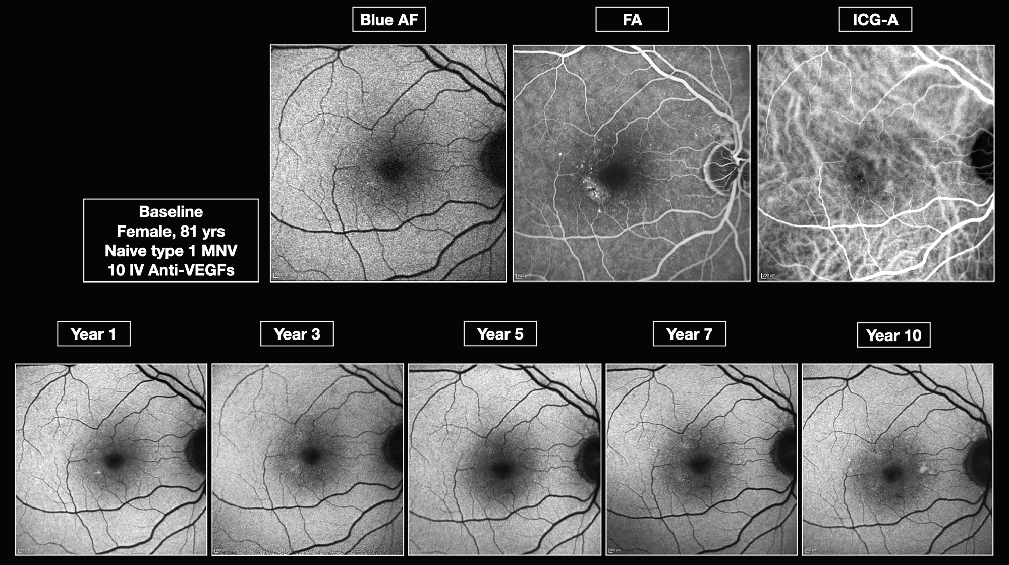 Figure 2. Type 1 choroidal neovascularization without geographic atrophy development over a 10-year period.