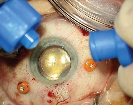 Surgical Scalpel – Retina Vitreous Associates